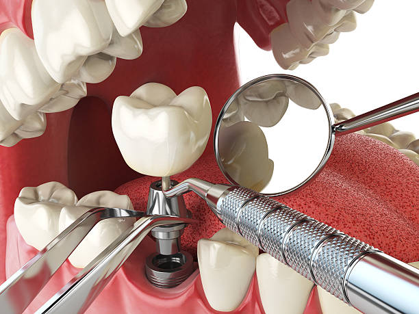Best Emergency Treatment for Oral Infections in Duvall, WA